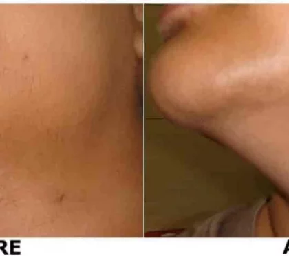 Navkeya Skin Clinic – Botox, dysport injections in Agra