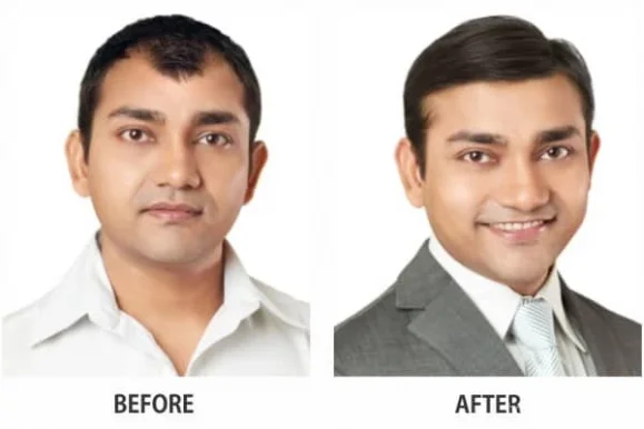 RichFeel Trichology Center - Best Hair Transplant & Hair Loss, Hair Fall Treatment in Chandigarh (Laser Facial Hair Removal), Chandigarh - Photo 2