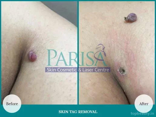 PARISA Skin Cosmetic & Laser Centre Dr Ashima Goel Skin Specialist in Chandigarh, Chandigarh - Photo 4