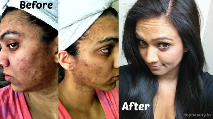 SkinWhitening/Pigmentation/Melasma/BlackPatches /Acnescar/Weight&InchLoss BodyShaping Treatment, Chennai - 