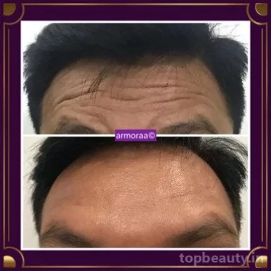 Armoraa Skin|Hair|Laser Clinic, Chennai - Photo 7