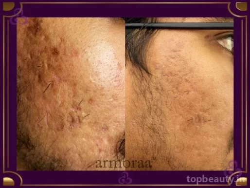 Armoraa Skin|Hair|Laser Clinic, Chennai - Photo 1