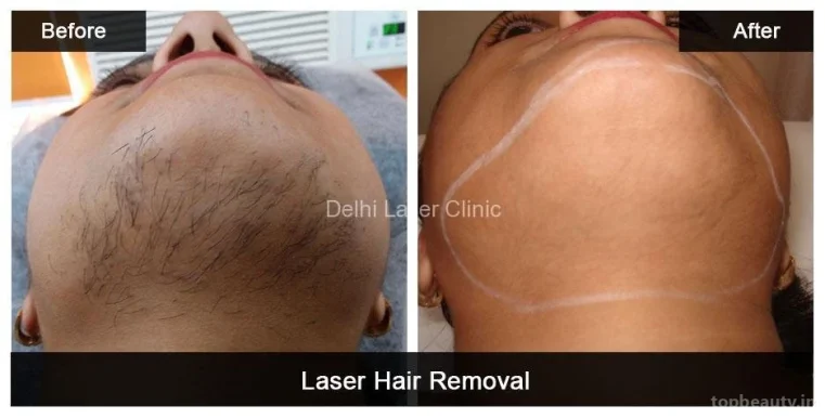 Delhi Laser Clinic: Laser Hair Removal, Acne Scar, Pigmentation, Tattoo Removal, Hydrafacial, Anti Aging Treatment in Delhi, Delhi - Photo 1