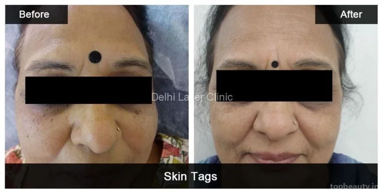 Delhi Laser Clinic: Laser Hair Removal, Acne Scar, Pigmentation, Tattoo Removal, Hydrafacial, Anti Aging Treatment in Delhi, Delhi - Photo 4