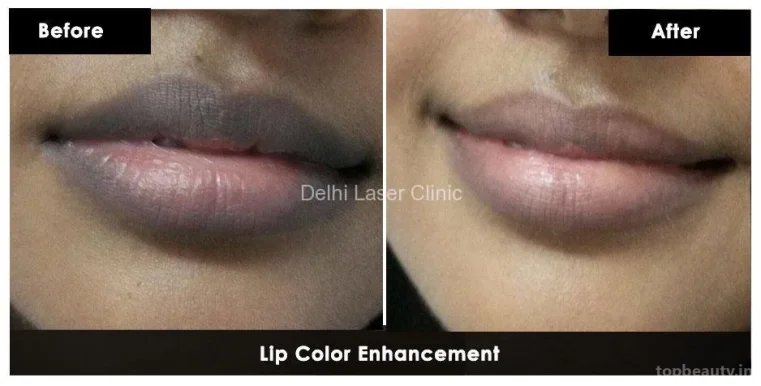 Delhi Laser Clinic: Laser Hair Removal, Acne Scar, Pigmentation, Tattoo Removal, Hydrafacial, Anti Aging Treatment in Delhi, Delhi - Photo 5