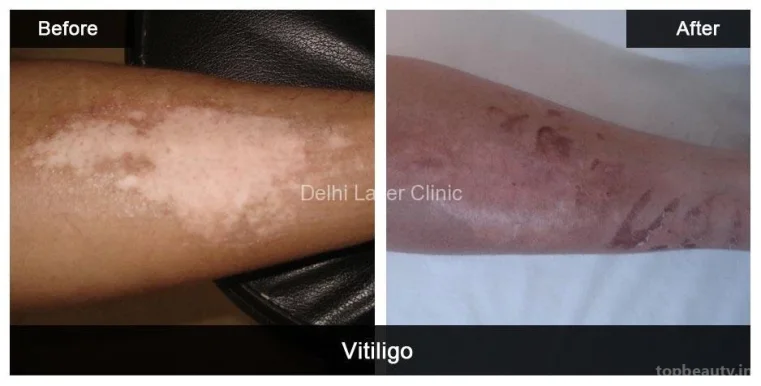 Delhi Laser Clinic: Laser Hair Removal, Acne Scar, Pigmentation, Tattoo Removal, Hydrafacial, Anti Aging Treatment in Delhi, Delhi - Photo 3