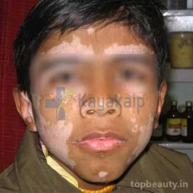 KayaKalp Global - Best Vitiligo Specialist in India, Faridabad - Photo 6