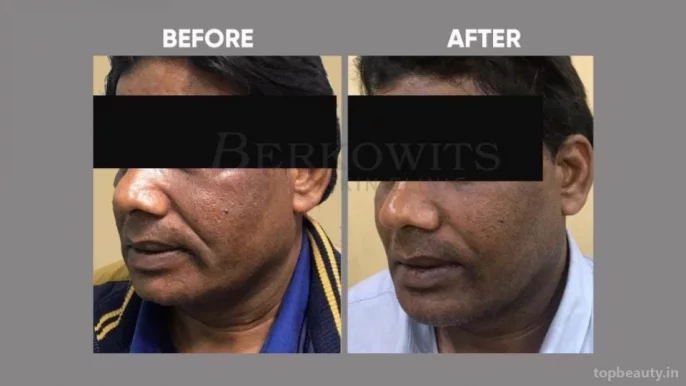 Berkowits Hair & Skin Clinic, Faridabad - Photo 3