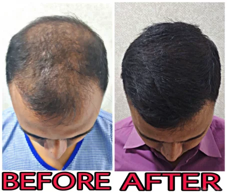 Delight Clinic, Best Hair Transplant Surgeon Gurgaon,Laser Hair Removal,PRP for Hair Loss,Fue Clinic, Gurgaon - Photo 8