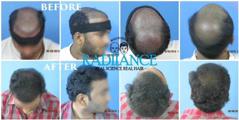 Radiance Advanced Hair Transplant Treatment Center in Hyderabad - Hair loss Treatment, Hyderabad - Photo 4