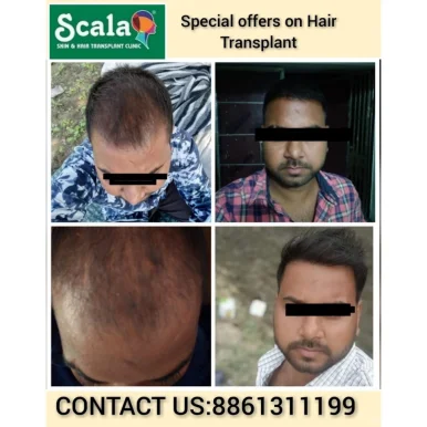 Scala Skin & Hair Transplant Clinic, Hyderabad - Photo 3