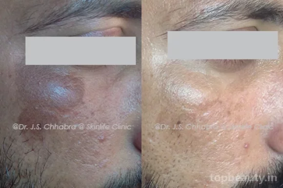 Dr. Chhabra's Skinlife Clinic, Indore - Photo 2