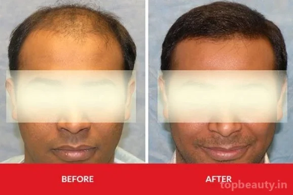 Elation Hair & Skin Clinic- Providing world class and latest Hair Transplant , Hair Loss Treatment and Skin Treatments, Kolkata - Photo 4
