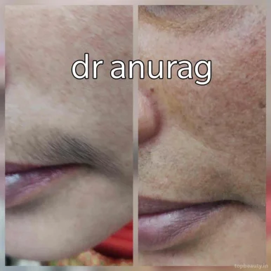 Dr Anurag Skin and Laser Clinic-Best Skin Doctor, Skin Specialist, Laser treatment ,Hair Transplant, PRP Treatment, Botox Treatment, Lucknow - Photo 6