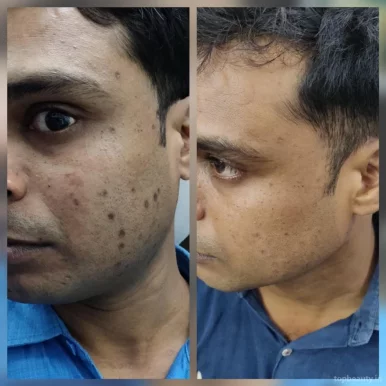 Dr Anurag Skin and Laser Clinic-Best Skin Doctor, Skin Specialist, Laser treatment ,Hair Transplant, PRP Treatment, Filler Treatment, Botox Treatment in Lucknow, Lucknow - Photo 3