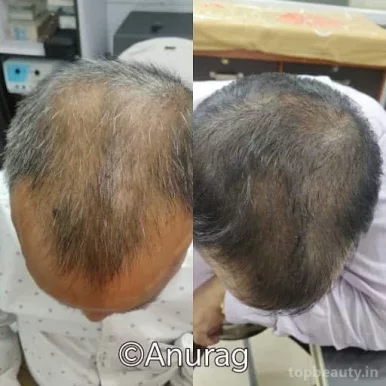 Dr Anurag Skin and Laser Clinic-Best Skin Doctor, Skin Specialist, Laser treatment ,Hair Transplant, PRP Treatment, Filler Treatment, Botox Treatment in Lucknow, Lucknow - Photo 8