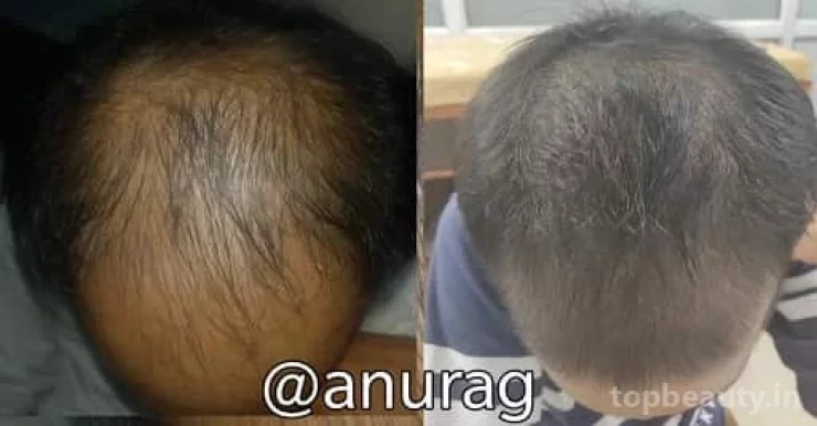 Dr Anurag Skin and Laser Clinic-Best Skin Doctor, Skin Specialist, Laser treatment ,Hair Transplant, PRP Treatment, Filler Treatment, Botox Treatment in Lucknow, Lucknow - Photo 5