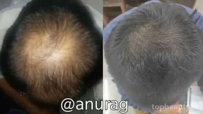 Dr Anurag Skin and Laser Clinic-Best Skin Doctor, Skin Specialist, Laser treatment ,Hair Transplant, PRP Treatment, Filler Treatment, Botox Treatment in Lucknow, Lucknow - Photo 2
