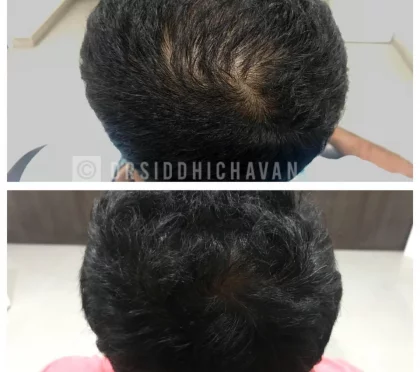 Dr. Siddhi Chavan – Hair toning in Mumbai