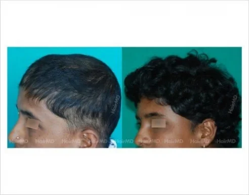HairMD Prabhat Road- Best Hair Clinic in Pune - Hair Transplant & Hair Loss Treatment in Pune, Pune - Photo 6
