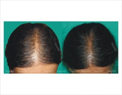 HairMD Prabhat Road- Best Hair Clinic in Pune - Hair Transplant & Hair Loss Treatment in Pune, Pune - Photo 3