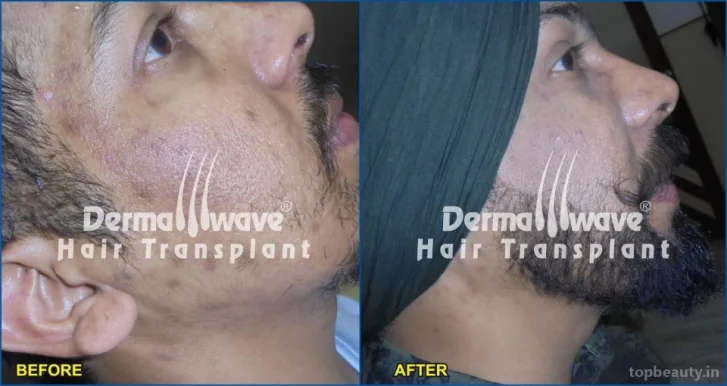 Dermawave Hair Transplant and Dermacare Skin & Laser Centre, Ranchi - Photo 6