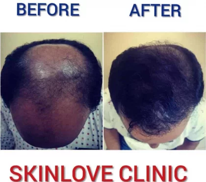 Skinlove Clinic – Chemical peel in Mumbai