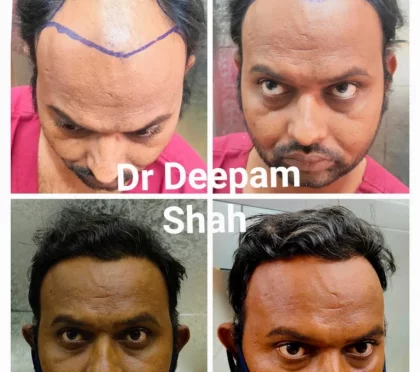 Viva Cosmetic Clinic by Dr. Deepam Shah - Dermatologist, Hair Transplant Surgeon in Opera House – Ultrasonic cavitation in Mumbai