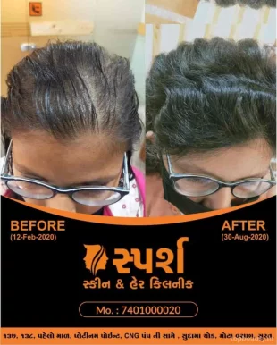 Sparsh skin and hair clinic, Surat - Photo 6
