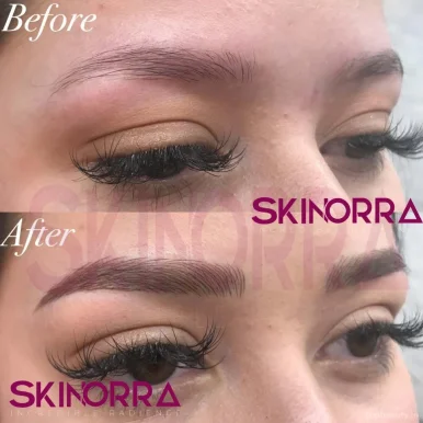 Skinorra - HydraFacial, Skin, Chemical peels, pmu permanent makeup, Vadodara - Photo 2