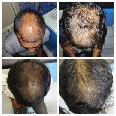 Aashrita Skin Hair & Cosmetology Clinic Dr Theeda Vinay Kumar Dermatologist, Visakhapatnam - Photo 5
